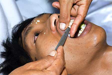 C�r�monie du limage des dents